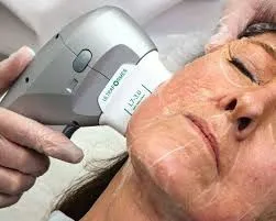 HIFU facial: precisión, método y firmeza sin cirugía